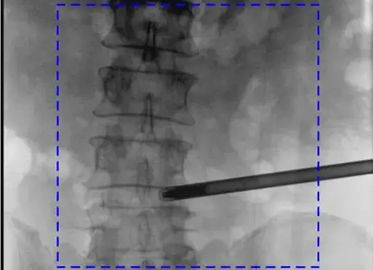 C臂機(jī)圖像不清楚的常見(jiàn)原因及解決辦法