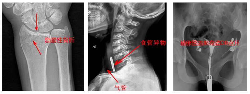 動態(tài)DR機準確點片 動態(tài)DR機準確點片