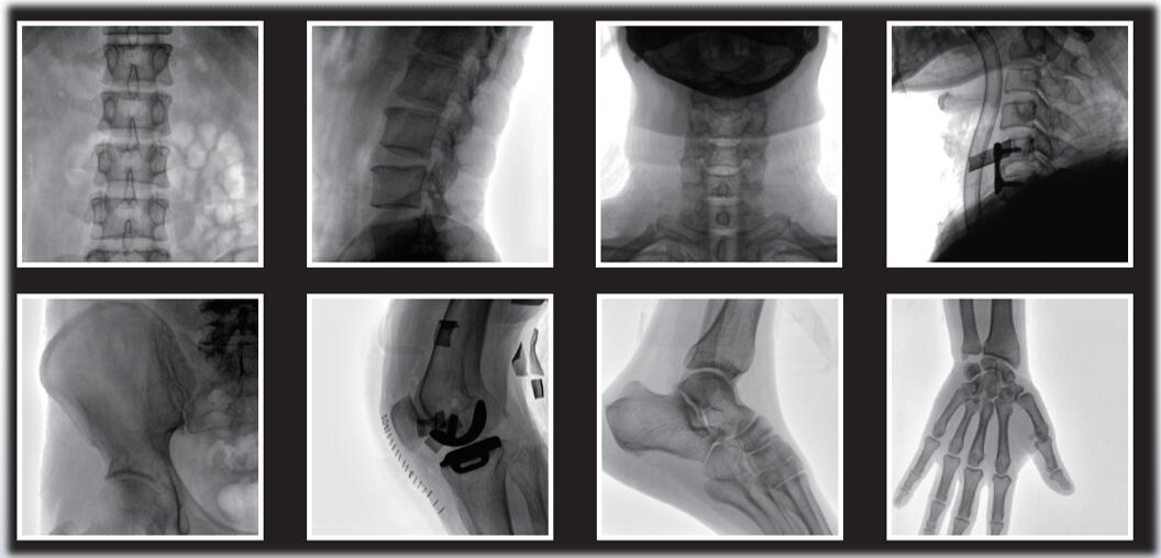 平板小C臂臨床影像 平板小C臂臨床影像