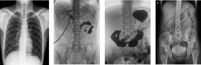 數(shù)字胃腸DR機造影 數(shù)字胃腸DR機造影