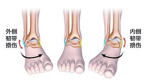 【醫(yī)療科普】之為什么說踝關(guān)節(jié)骨折手術(shù)復(fù)雜? 【醫(yī)療科普】之為什么說踝關(guān)節(jié)骨折手術(shù)復(fù)雜?