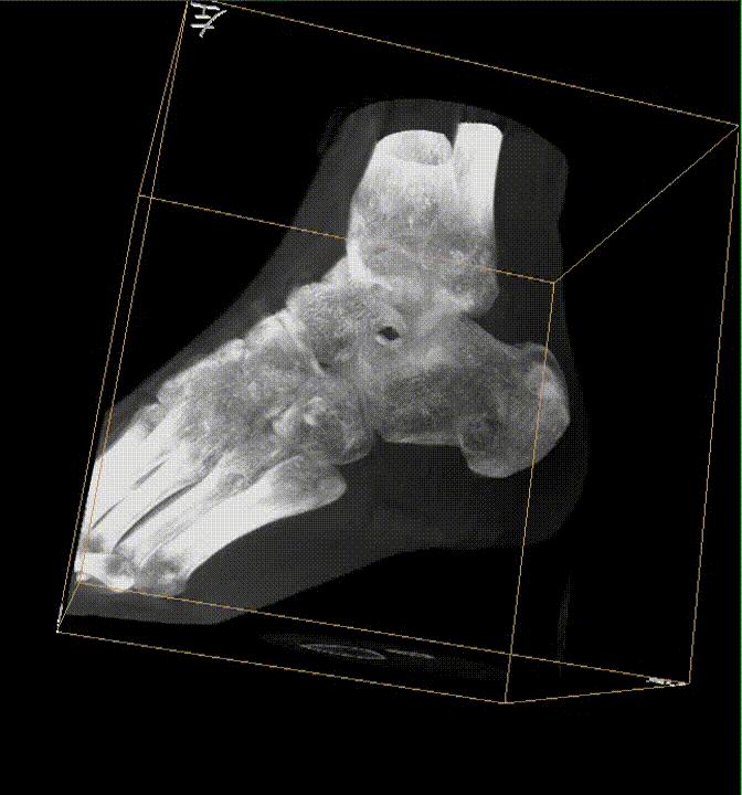 【醫(yī)療科普】之為什么說踝關(guān)節(jié)骨折手術(shù)復(fù)雜? 【醫(yī)療科普】之為什么說踝關(guān)節(jié)骨折手術(shù)復(fù)雜?