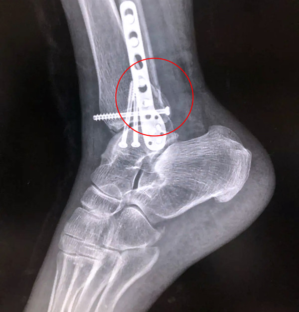 【醫療科普】之后踝骨折 【醫療科普】之后踝骨折