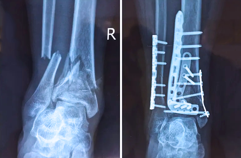 【醫(yī)療科普】:關節(jié)內(nèi)的骨折 【醫(yī)療科普】:關節(jié)內(nèi)的骨折