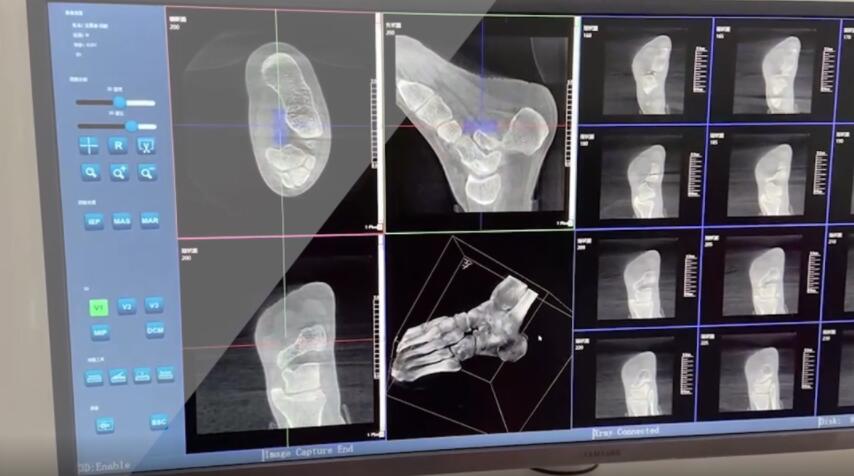 【醫(yī)療科普】:踝關節(jié)三維掃描 【醫(yī)療科普】:踝關節(jié)三維掃描