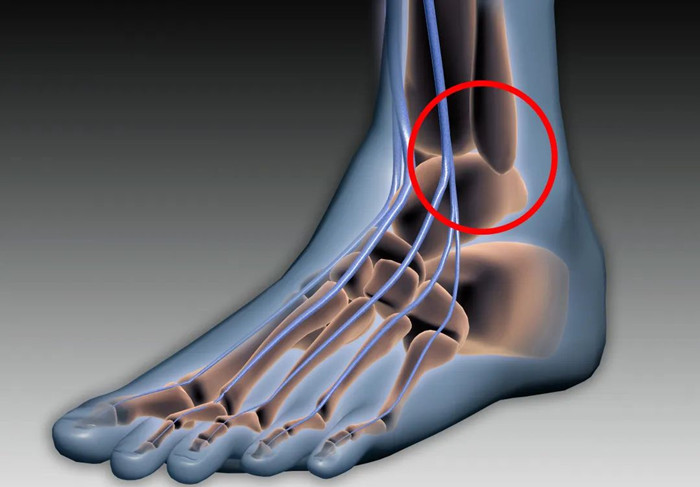 【醫療科普】:下脛腓關節復位 【醫療科普】:下脛腓關節復位
