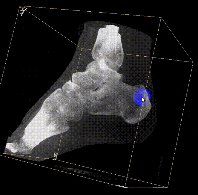 【醫療科普】:三維影像提高手術的精度 【醫療科普】:三維影像提高手術的精度