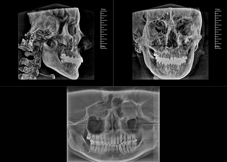 數字化口腔CBCT影像 數字化口腔CBCT影像