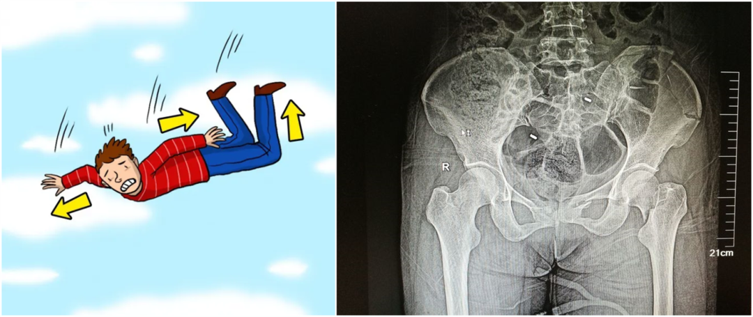 【醫(yī)療科普】:外傷性骨折影像 【醫(yī)療科普】:外傷性骨折影像