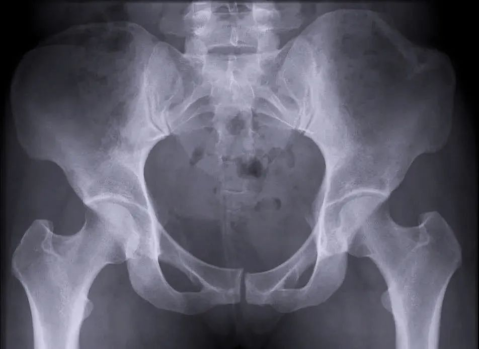 【醫(yī)療科普】:穩(wěn)定性骨折影像 【醫(yī)療科普】:穩(wěn)定性骨折影像