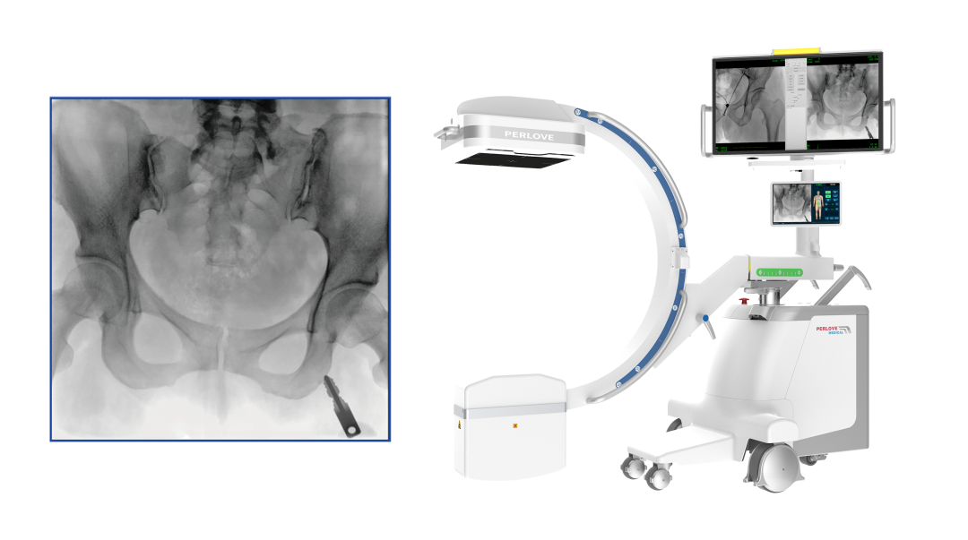 【醫(yī)療科普】:大尺寸平板C形臂提供更多圖像細(xì)節(jié) 【醫(yī)療科普】:大尺寸平板C形臂提供更多圖像細(xì)節(jié)