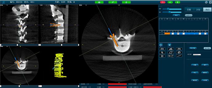 脊柱手術機器人準確定位 脊柱手術機器人準確定位