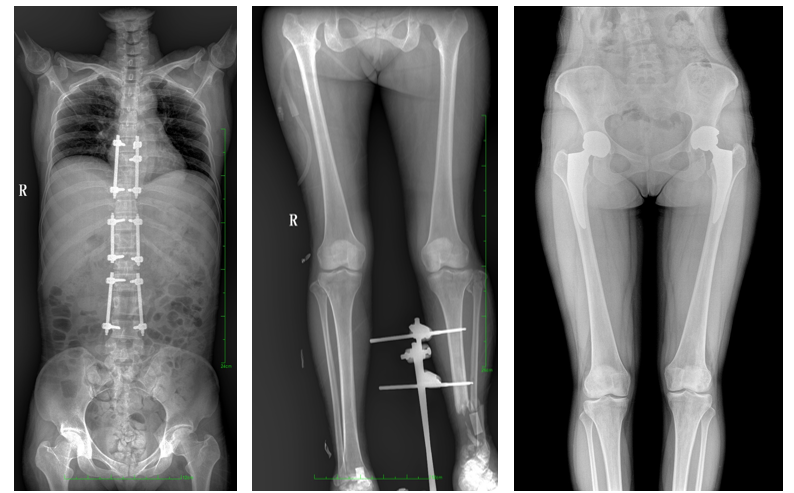大視野平板動態DR影像 大視野平板動態DR影像