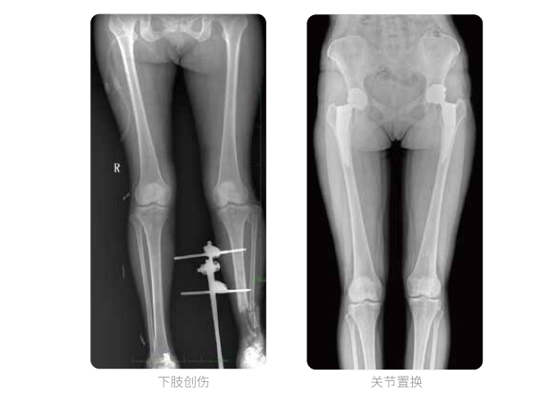 動(dòng)態(tài)DR的雙下肢臨床影像 動(dòng)態(tài)DR的雙下肢臨床影像