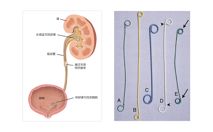 輸尿管支架工作原理及常見的雙J管 輸尿管支架工作原理及常見的雙J管