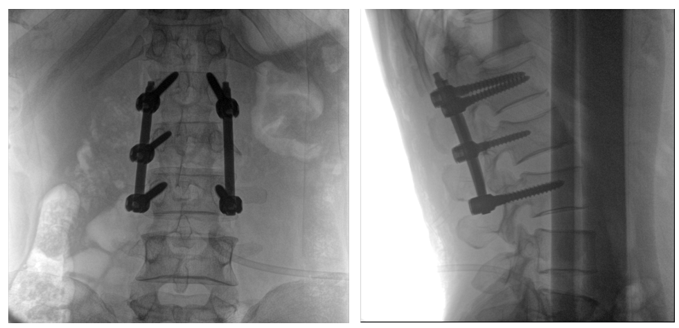 移動式一體化C形臂全節段腰椎臨床影像 移動式一體化C形臂全節段腰椎臨床影像